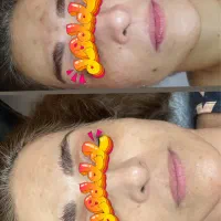 درمان قطعی لک و جوش در کوتاهترین زمان|خدمات آرایشگری و زیبایی|مشهد, چهارچشمه|دیوار