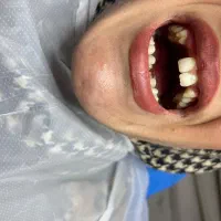 آموزش تخصصی کامپوزیت دندان با برد تخصصی