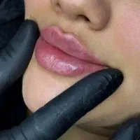 تزریق ژل وفیلر۳۹۹تومن