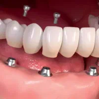 لطفاً درمورد دندان پوسیده راهنمایی میخواستم