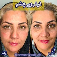 تزریق انواع بوتاکس ژل آنزیم بینی نخ جوانسازی|خدمات آرایشگری و زیبایی|صدرا-فارس, فاز ۱|دیوار