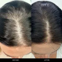 درمان قطعی ریزش مو