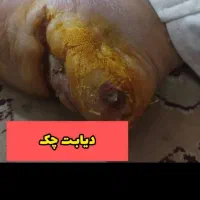 درمان قطعی دیابت  رویا نیست