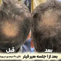 درمان ریزش مو و رویش مجدد با بهترین متریال|خدمات آرایشگری و زیبایی|تهران, امام حسین|دیوار
