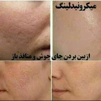 جشنواره تخفیف ویژه تابستانی  پاکسازی تخصص پوست|خدمات آرایشگری و زیبایی|نوشهر, |دیوار