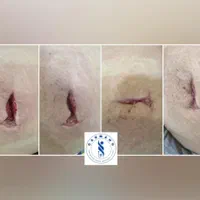 کلینیک تخصصی درمان انواع زخم(بستر و دیابت) فردوس|خدمات آرایشگری و زیبایی|اصفهان, محله سفلی|دیوار