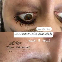 پاکسازی /کاموفلاژ/بیبیگلو/تیرگی زیر چشم/میکرو مزو