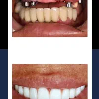 ایمپلنت تخصصی از ۷میلیون+ اوردنچر/ تخفیف تاآخرآذر|خدمات آرایشگری و زیبایی|اصفهان, جلفا|دیوار