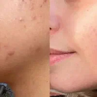 درمان جوش صورت و بدن|خدمات آرایشگری و زیبایی|دوگنبدان, |دیوار