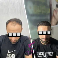 کاشت مو با شرایط اقساط تضمینی|خدمات آرایشگری و زیبایی|اردبیل, |دیوار