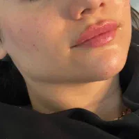 بوتاکس،فیلر توسط پزشک پوست و زیبایی(تخفیف استثنایی