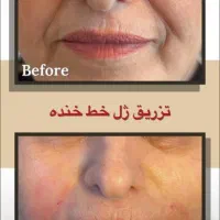 مادلینگ صورت( ژل و بوتاکس)|خدمات آرایشگری و زیبایی|زرقان, |دیوار