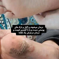 درمان زگیل و میخچه