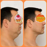 ساکشن غبغب و زاویه سازی تخصصی ویژه آقایان