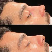 تخفیف عمل بینی لیپو ابدو لیفت ابرو وکاشت ابرو و مو|خدمات آرایشگری و زیبایی|اسلامشهر, شهرک لاله|دیوار