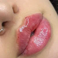 ژل و بوتاکس مشهد