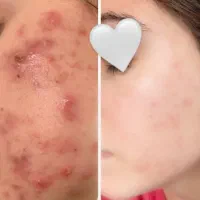 جوش و جای جوش