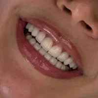 جشنواره/تابستانه/کامپوزیت /دندان