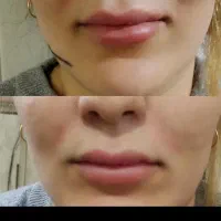 تزریق ژل بوتاکس مزو نخ جوانساز باقیمت مناسب درمنزل|خدمات آرایشگری و زیبایی|شهرضا, |دیوار