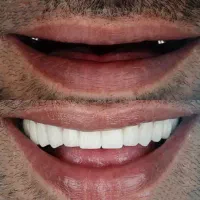 ایمپلنت دندان بدون جراحی
