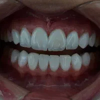 کامپوزیت.لمینت