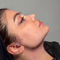 وی لاین تکنیک انحصاری کیلینیک مهرزاد ساکشن غبغب|خدمات آرایشگری و زیبایی|تهران, الهیه|دیوار