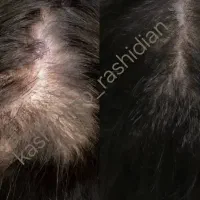 پی آر پی و مزوتراپی prp مو و ابرو|خدمات آرایشگری و زیبایی|اردبیل, |دیوار