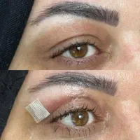 آموزش بلفاروپلاستی لیزری|خدمات آموزشی|تهران, ونک|دیوار