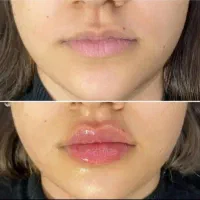 تزریق فیلر بادی(هیپ دیپ) ژل و بوتاکس