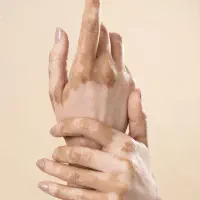 مشاوره تخصصی و برنامه مدیریت بیماری ویتیلیگو