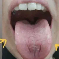 تشخیص بیماری از روی زبان