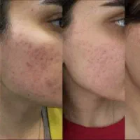 معجزه درمان جوش و جای جوش