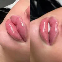 ژل و بوتاکس