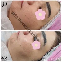 پاکسازی آبرسانی و فیشال پوست صورت|خدمات آرایشگری و زیبایی|تهران, حکیمیه|دیوار