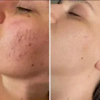 درمان لک،جوش،کک و مک