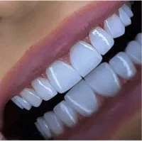 دندانپزشکی کامپوزیت ونیر فقط 9میلیون اقساطی