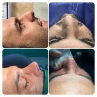 عمل زیبایی عمل بینی