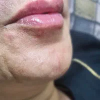 ژل وبوتاکس|خدمات آرایشگری و زیبایی|مشهد, ایثارگران|دیوار