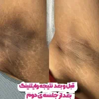 بلک فرایدی وایتنینگ تخصصی بیکینی زیربغل زانو