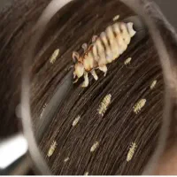 رفع قطعی شپش فقط در یک جلسه