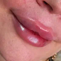 آموزش پیشرفته ژل و بوتاکس توسط پزشک