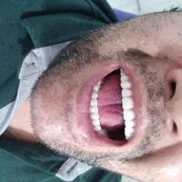 دندانسازی (دندان مصنوعی)پروتز متحرک|خدمات آرایشگری و زیبایی|قم, شاه ابراهیم|دیوار