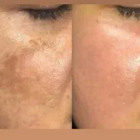 خال برداری و رفع کک ومک|خدمات آرایشگری و زیبایی|رشت, رودباری|دیوار