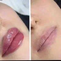 ژل و بوتاکس مزو ژل تزریق چربی نخ تخفیف 50درصدی