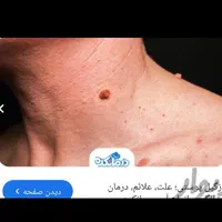 خدمات پرستاری و درمان و برداشتن انواع زگیل
