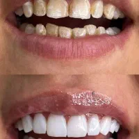 کامپوزیت دندان|خدمات آرایشگری و زیبایی|فولادشهر, B2|دیوار