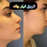 خدمات تخصصی تزریق ژل و بوتاکس|خدمات آرایشگری و زیبایی|فولادشهر, C3|دیوار