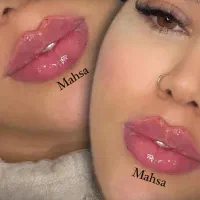 ژل وبوتاکس ژل لب‌،چانه، گونه ،زاویه،خط لبخندفقط۳۵۰