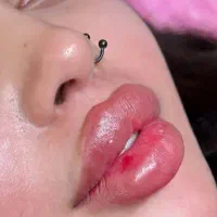 تزریق ژل و بوتاکس تخصصی