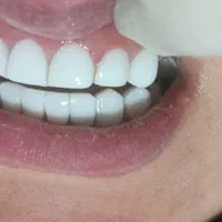 کامپوزیت دندان|خدمات آرایشگری و زیبایی|نورآباد, |دیوار